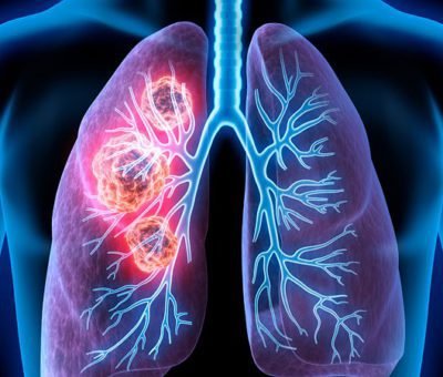 Akciğer kanseri, kanser ölümlerinde ilk sırada yer alıyor