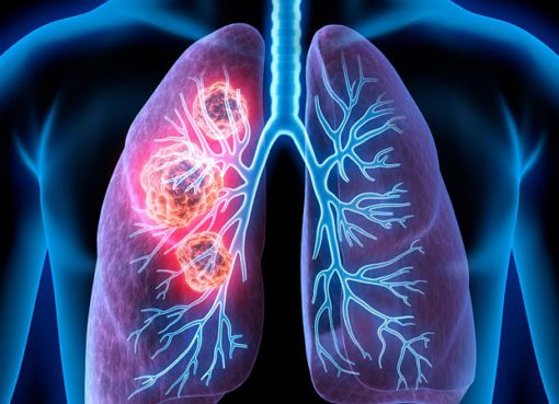 Akciğer kanseri, kanser ölümlerinde ilk sırada yer alıyor