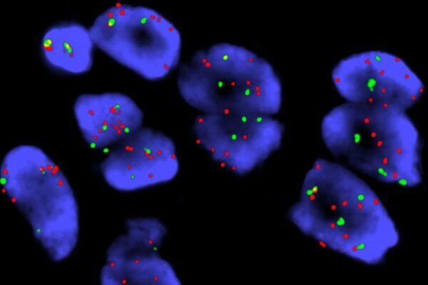 Akciğer kanseri tanısında kullanılan moleküler testler ve test süreçlerini anlatan, Türkiye'de bu konuda ilk ve tek ulusal rehber olma niteliğini de taşıyan “Küçük Hücreli Dışı Akciğer Kanseri için Moleküler Testler Tanı Rehberi”nin 2021 yılının son aylarında güncellenen versiyonunda, tüm moleküler testlere ve biyopsi süreçlerine yönelik gelişmelere yer veriliyor. AstraZeneca Türkiye ve Roche Diagnostik Türkiye'nin koşulsuz katkıları ile Patoloji Dernekleri Federasyonu'nun hazırladığı rehberdeki içerikler hakkında İstanbul, Ankara ve İzmir'de yapılan yüz yüze toplantılarda editör hekimler tarafından katılımcılara detaylı bilgiler verildi.