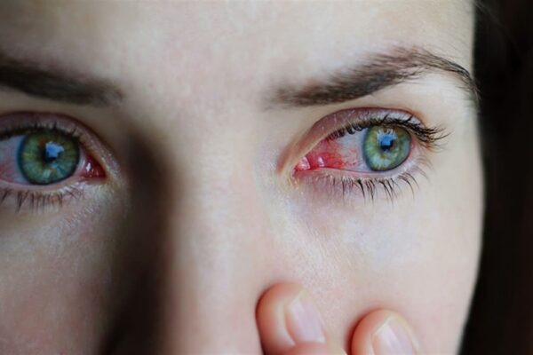 Çeşitli nedenler ile sıklıkla karşılaşılan ve halk arasında kırmızı göz hastalığı olarak da bilinen, göz iltihaplanması şeklinde kendini gösteren konjonktivit hastalığıyla ilgili uyarılarda bulunan Göz Hastalıkları ve Retina Cerrahisi Uzmanı Prof. Dr. Nur Acar Göçgil, “Konjonktivit, gözün beyaz kısmını veya sklerayı örten ve göz kapaklarının iç kısmını kaplayan ince yüzey dokunun iltihaplanmasıdır. Çok ince damarlardan zengin bu şeffaf katman aynı zamanda gözün nemli kalmasını sağlayan maddeleri üretir ve salgılar. Konjonktivit hastalığı kan damarlarımızın daha büyük ve belirgin bir hale gelerek gözlerimizin kırmızı görünmesine yol açar. Hastalık sadece bir veya iki gözde aynı anda oluşabilmektedir” dedi.