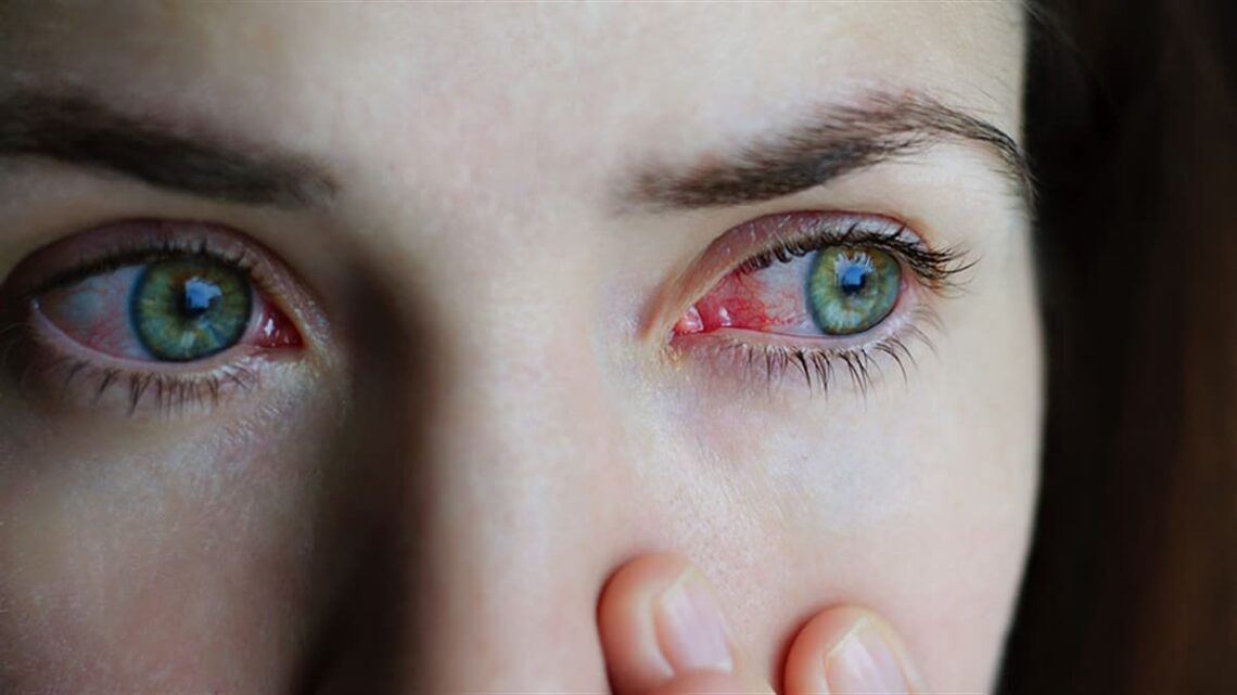 Çeşitli nedenler ile sıklıkla karşılaşılan ve halk arasında kırmızı göz hastalığı olarak da bilinen, göz iltihaplanması şeklinde kendini gösteren konjonktivit hastalığıyla ilgili uyarılarda bulunan Göz Hastalıkları ve Retina Cerrahisi Uzmanı Prof. Dr. Nur Acar Göçgil, “Konjonktivit, gözün beyaz kısmını veya sklerayı örten ve göz kapaklarının iç kısmını kaplayan ince yüzey dokunun iltihaplanmasıdır. Çok ince damarlardan zengin bu şeffaf katman aynı zamanda gözün nemli kalmasını sağlayan maddeleri üretir ve salgılar. Konjonktivit hastalığı kan damarlarımızın daha büyük ve belirgin bir hale gelerek gözlerimizin kırmızı görünmesine yol açar. Hastalık sadece bir veya iki gözde aynı anda oluşabilmektedir” dedi.